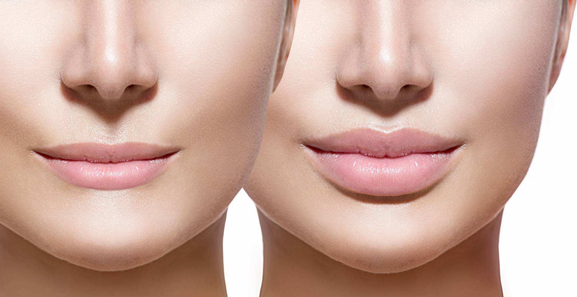 Lip Augmentation Near Me Lip Filler Aventura, Miami